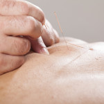dry needling