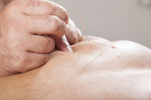 dry needling